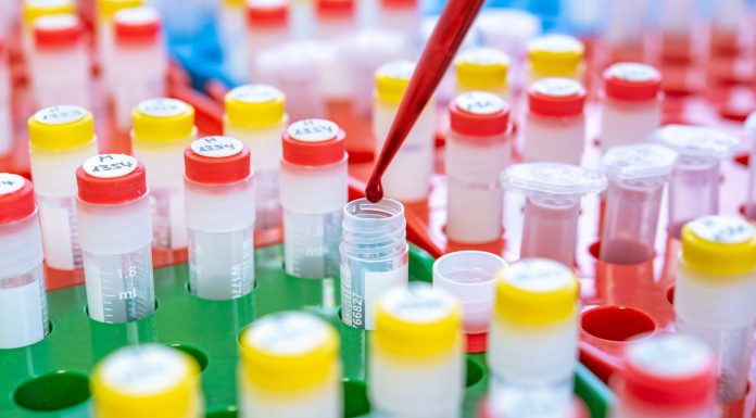 Diagnosis of trisomy 21: the Federal Committee for Fund financing of trisomy test