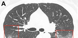There were pictures of lungs affected by coronavirus