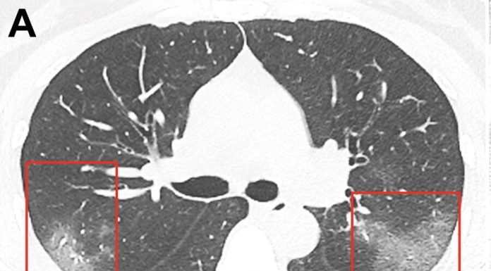 There were pictures of lungs affected by coronavirus
